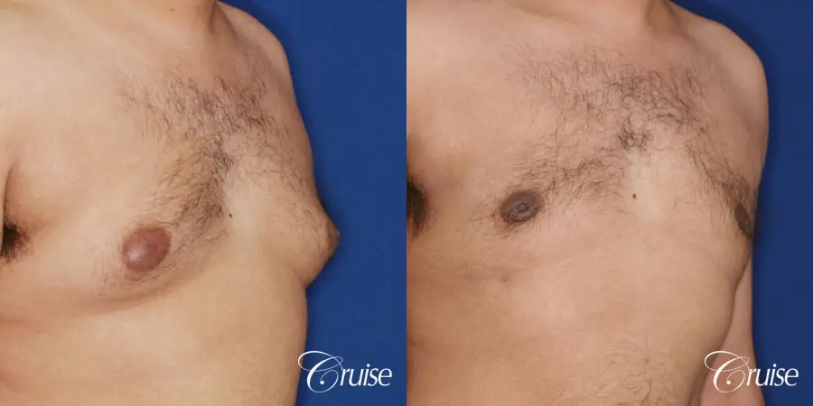 best scar on 32 gynecomastia patient - Before and After 3