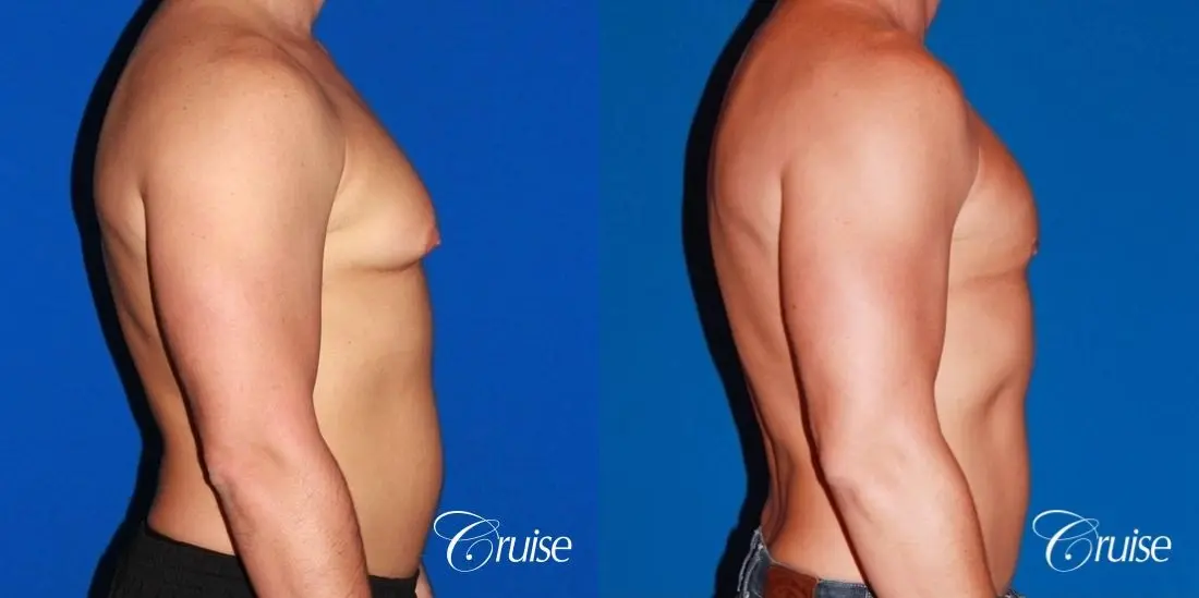 body builder with Gynecomastia puffy nipple - Before and After 5