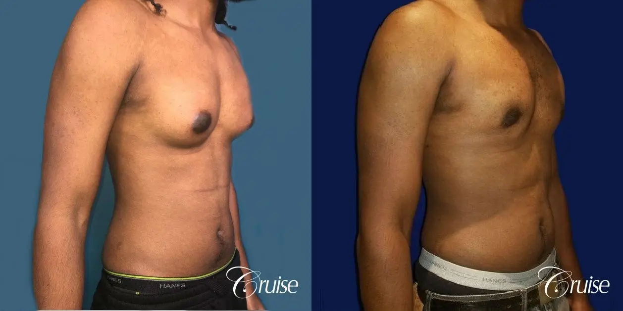 Type 3 Gynecomastia Gland Removal & Skin Tightening - Before and After 3