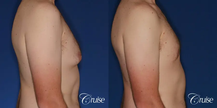 gynecomastia with skin laxity - Before and After 4