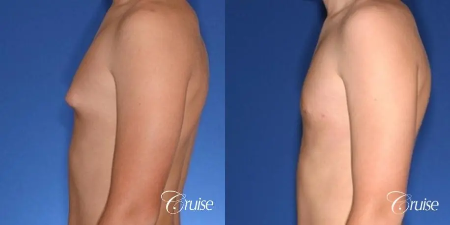 teenage gynecomastia with puffy nipple - Before and After 2