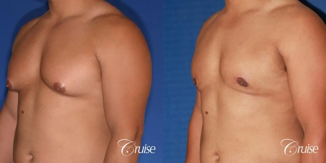 donut lift gynecomastia moderate adult - Before and After 2