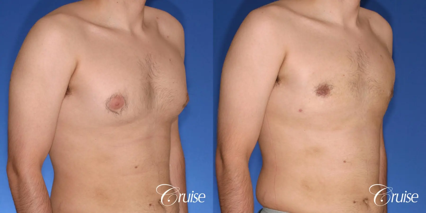 moderate gynecomastia puffy nipple - Before and After 4