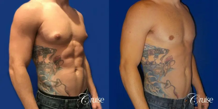 body builder puffy nipple gynecomastia - Before and After 4