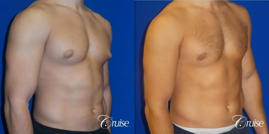 male breast reduction surgery newport beach - Before and After 2
