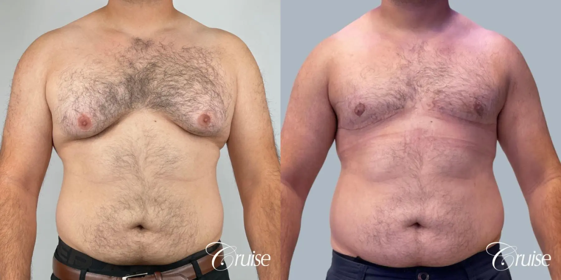 Gynecomastia: Patient 9 - Before and After  