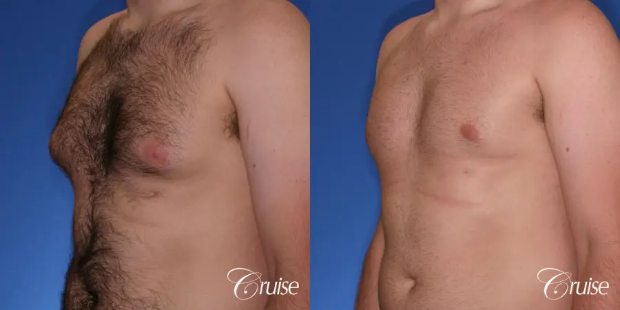 best Puffy nipple correction and gynecomastia on young adult - Before and After 3