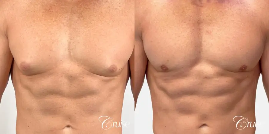 gynecomastia removal - Before and After 1