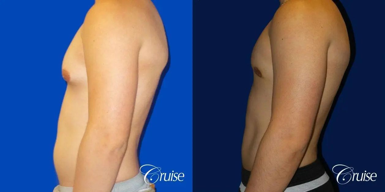 Best Gynecomastia surgeons Southern California - Before and After 2