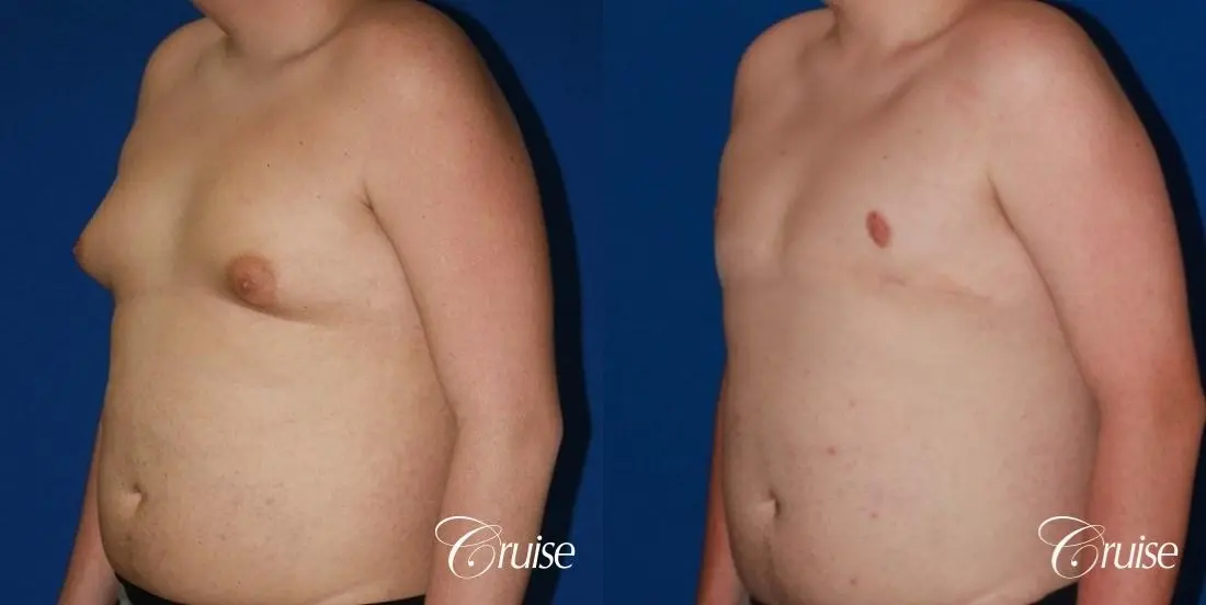 moderate gynecomastia with free nipple graft scar on teenager - Before and After 2