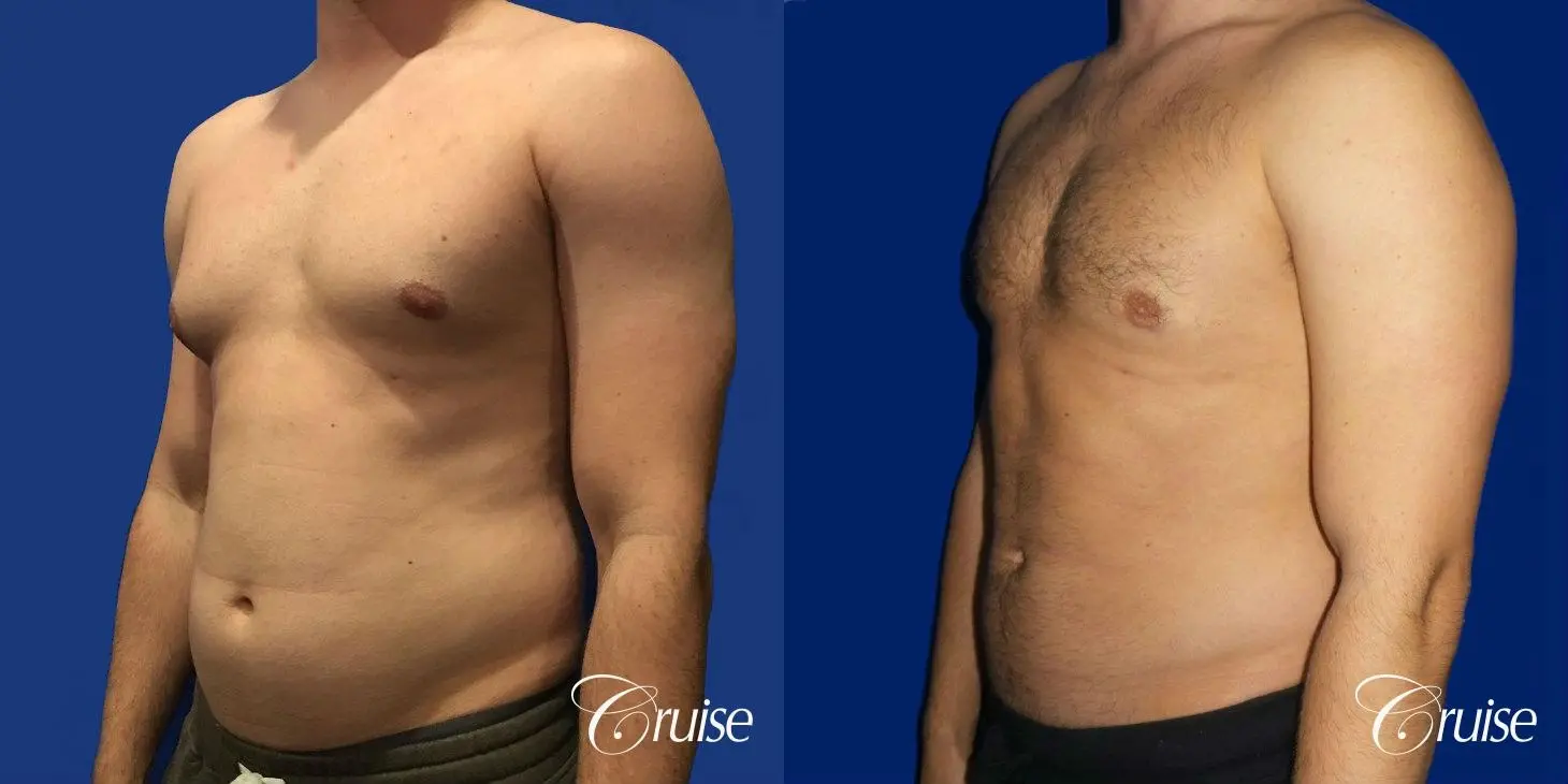 Type 2/3 Asymmetric Gynecomastia  - Before and After 2