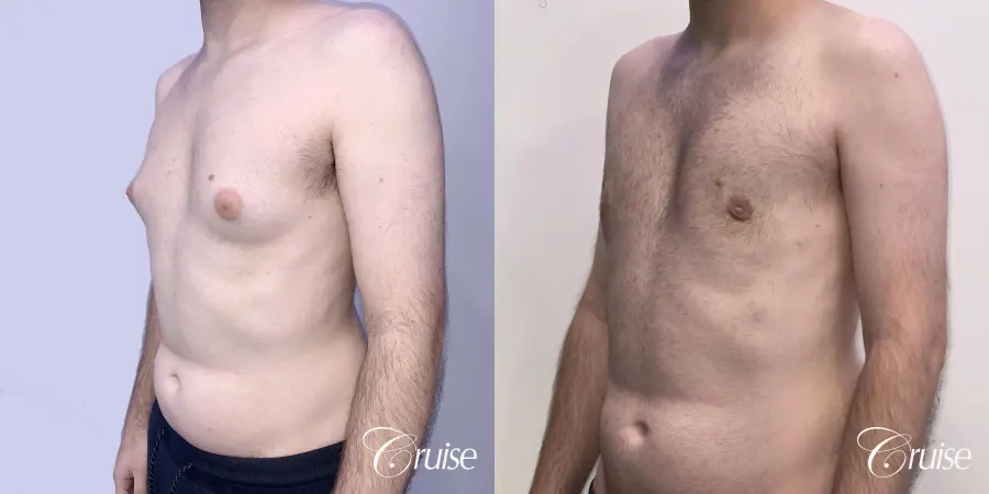 Gynecomastia: Patient 132 - Before and After 3