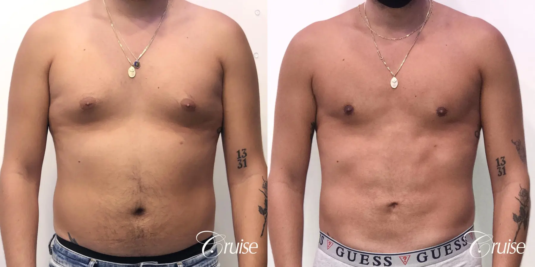 gynecomastia correction orange county - Before and After 1