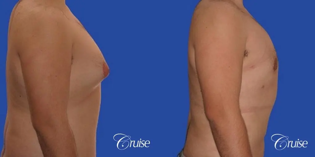 Gynecomastia with pointy nipples - Before and After 4