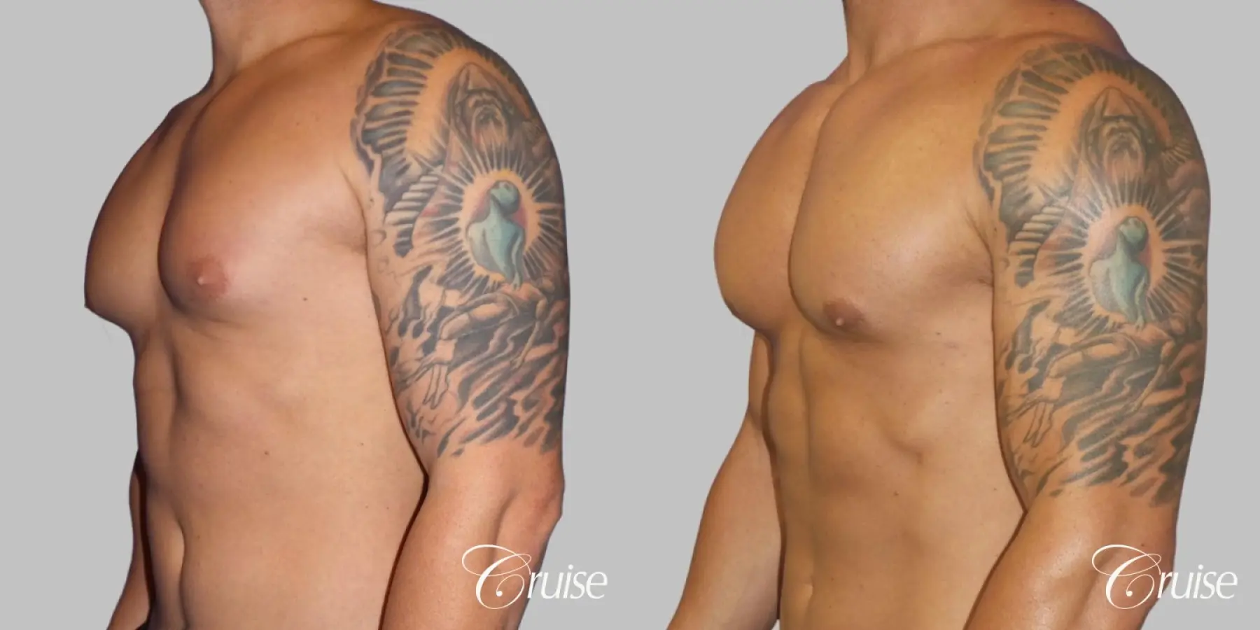 Gynecomastia puffy nipples cost - Before and After 4