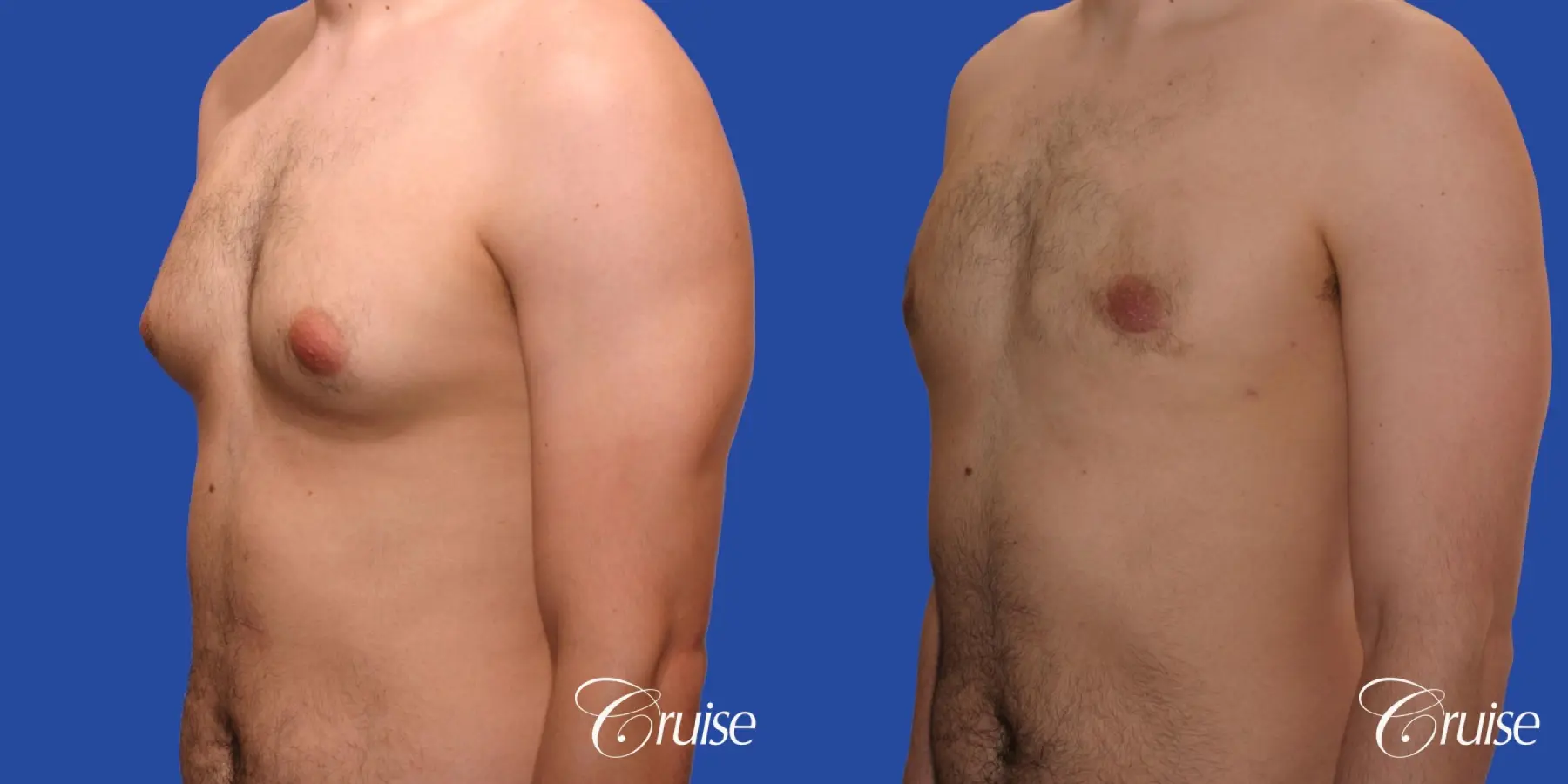 Type 2 Gynecomastia Young Adult - Before and After 3