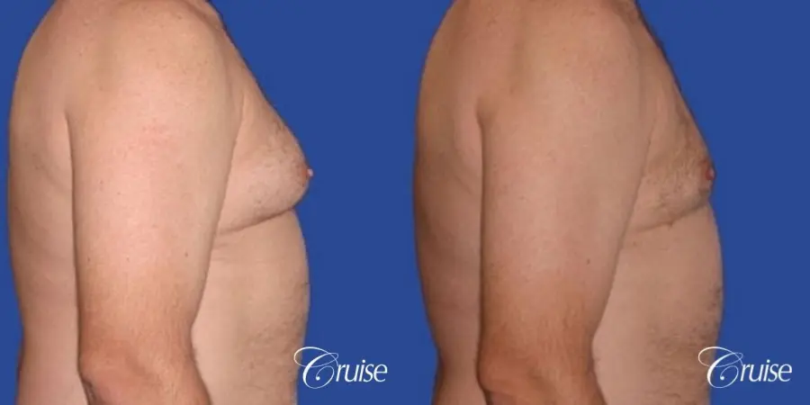 chest liposuction on adult - Before and After 3