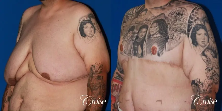 severe gynecomastia with free nipple graft on adult - Before and After 3