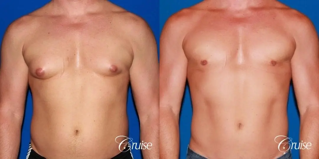 body builder with Gynecomastia puffy nipple - Before and After