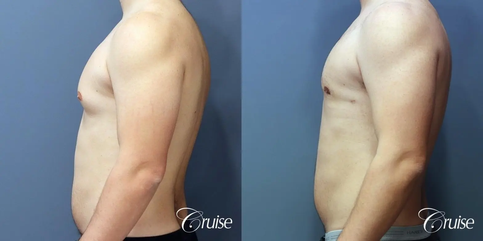 Gynecomastia: Patient 147 - Before and After 3