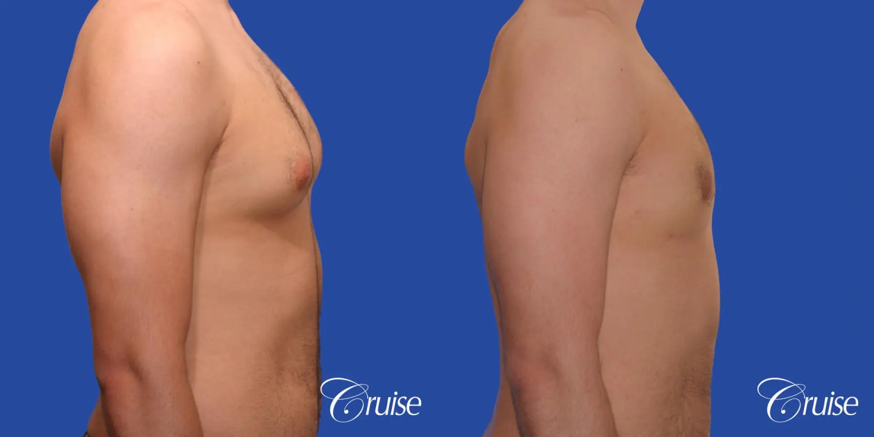Type 2 Gynecomastia Young Adult - Before and After 4