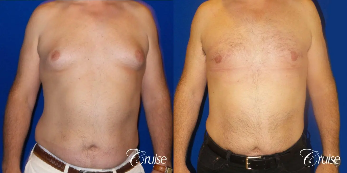gynecomastia surgery results - Before and After 1