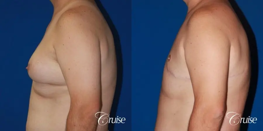 male breast severe gynecomastia free nipple graft anchor - Before and After 2
