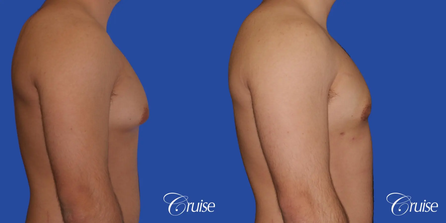 mild case of gynecomastia on adult - Before and After 3