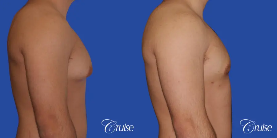 mild case of gynecomastia on adult - Before and After 3