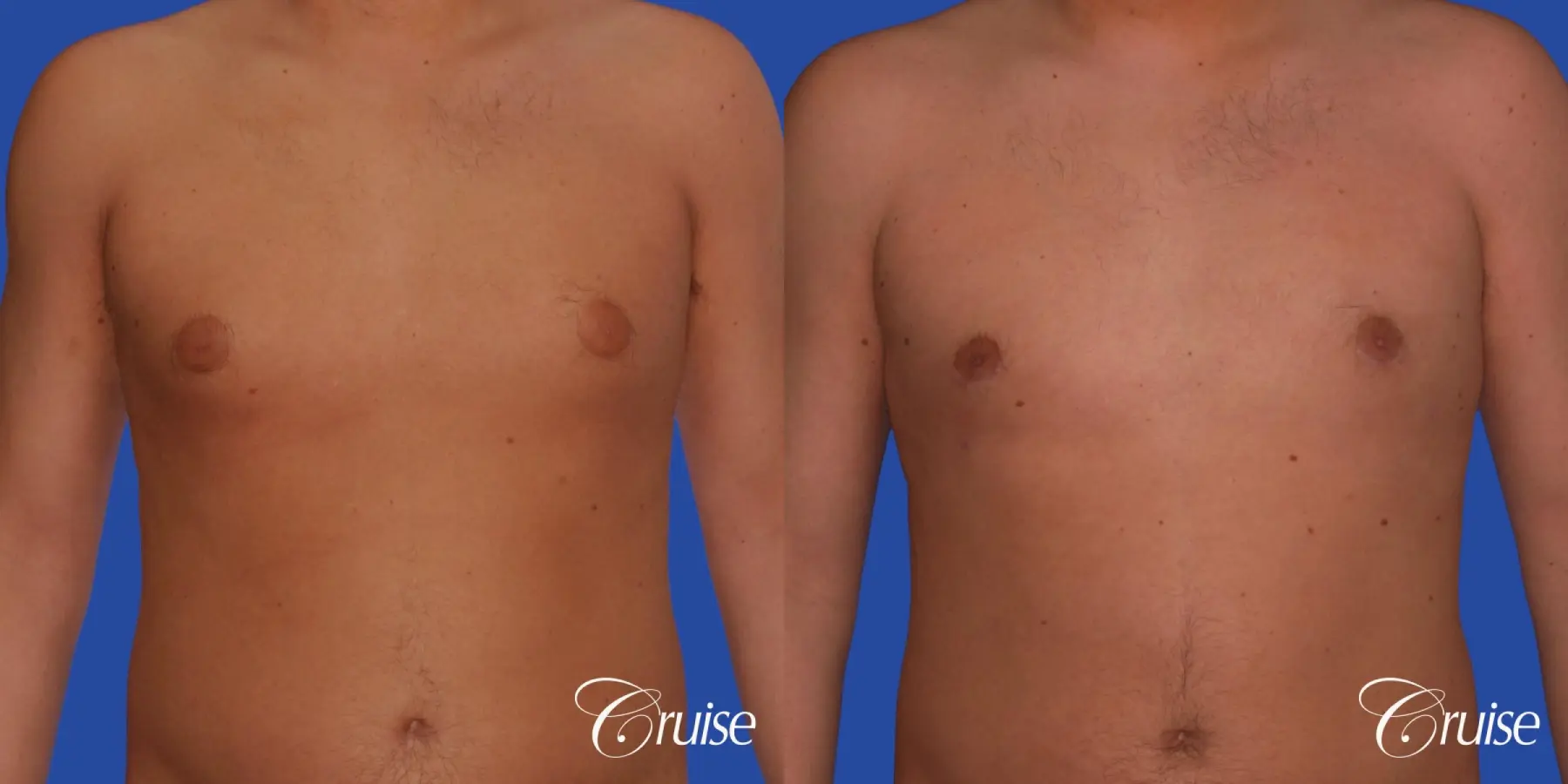 best puffy nipple gynecomastia results with plastic surgeon, Joseph Cruise, M.D. - Before and After 1