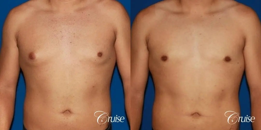puffy nipple on 26 year old with gynecomastia - Before and After 1