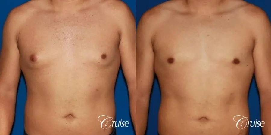 puffy nipple on 26 year old with gynecomastia - Before and After 1