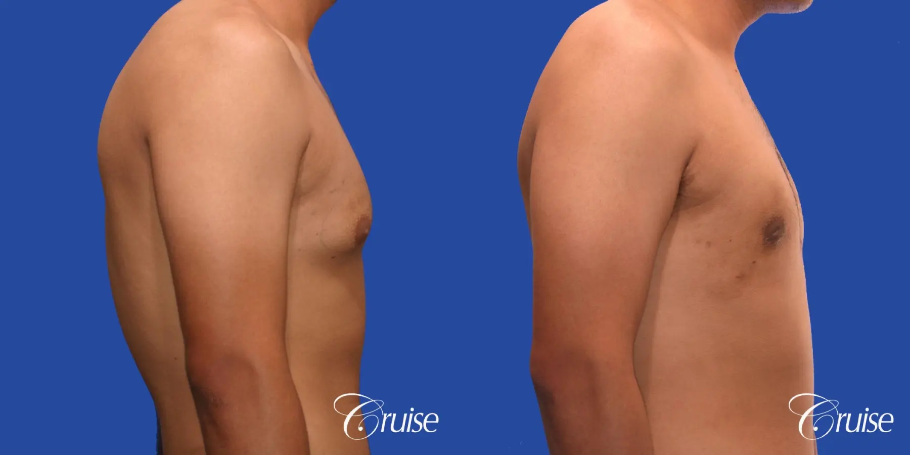 mild gynecomastia standard PA areola incision - Before and After 4