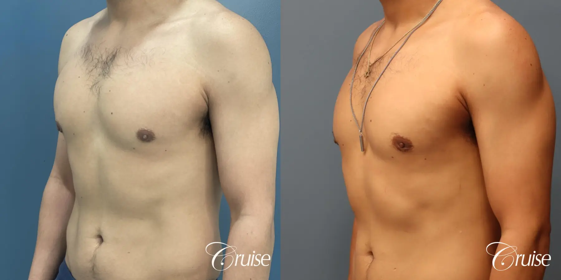 Gynecomastia: Patient 141 - Before and After 4