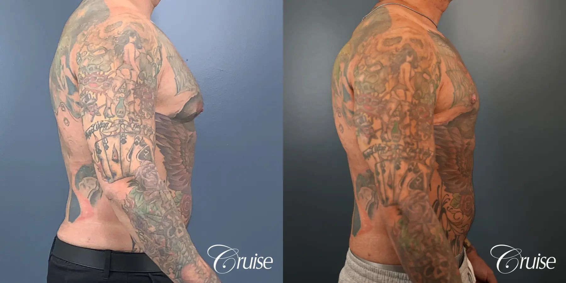 Gynecomastia: Patient 143 - Before and After 4
