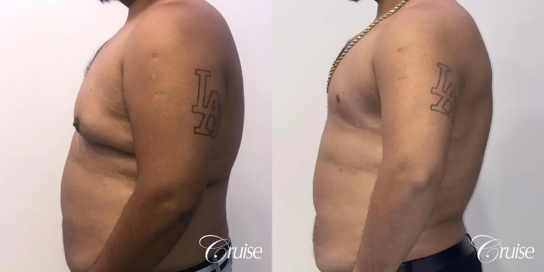 Gynecomastia: Patient 133 - Before and After 2