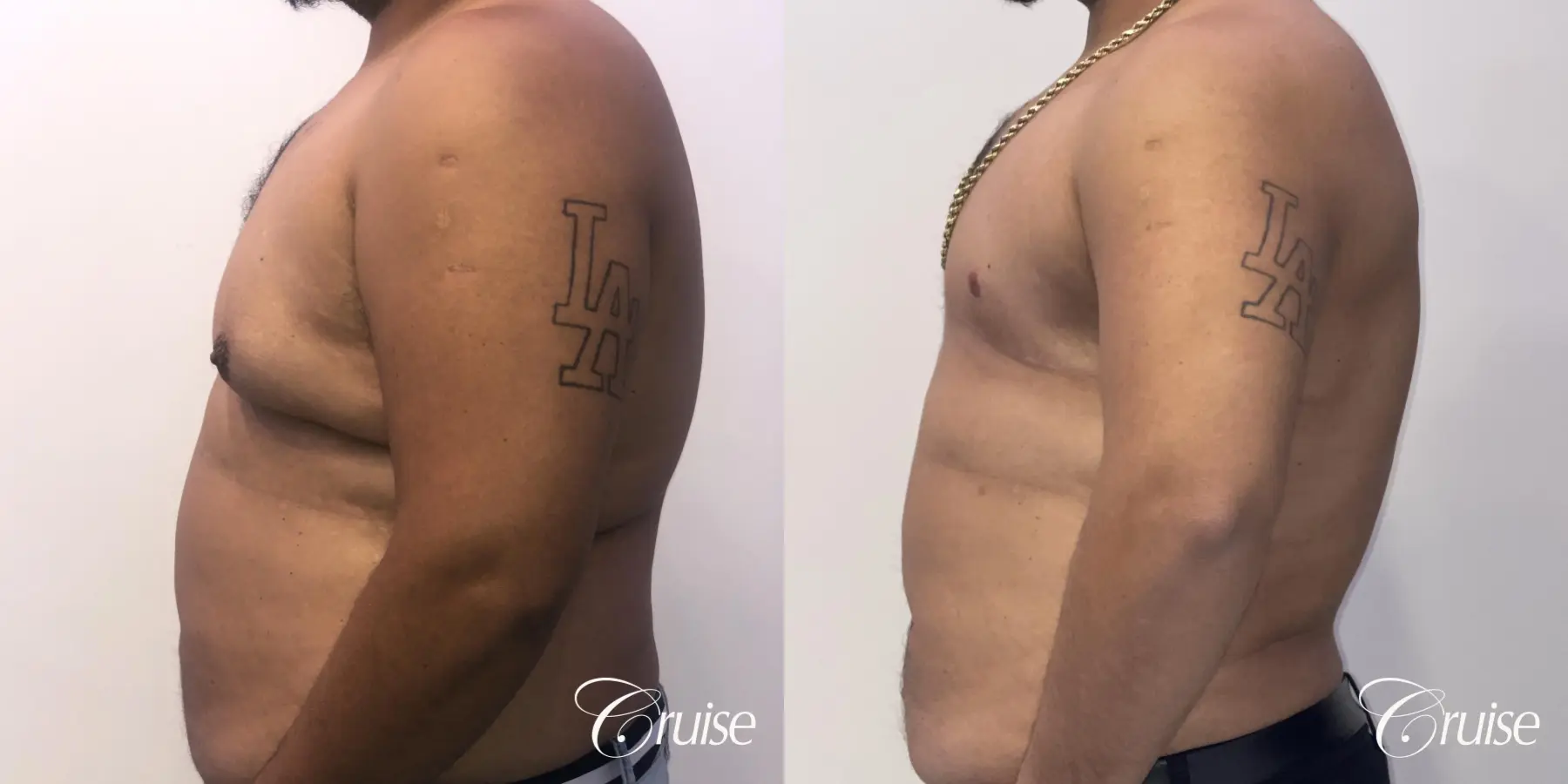 Gynecomastia: Patient 135 - Before and After 2