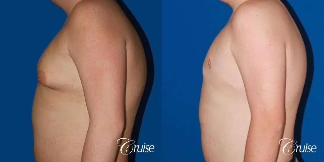moderate gynecomastia with free nipple graft scar on teenager - Before and After 3
