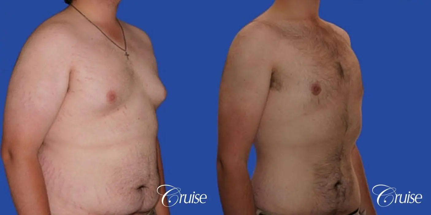 weight loss patient with gynecomastia - Before and After 3