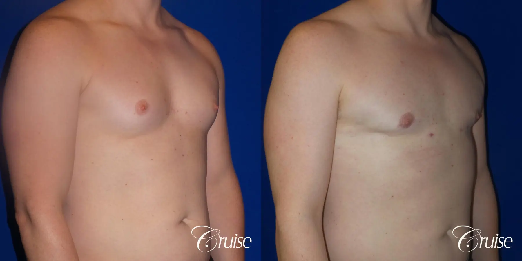 Gynecomastia: Patient 148 - Before and After 2