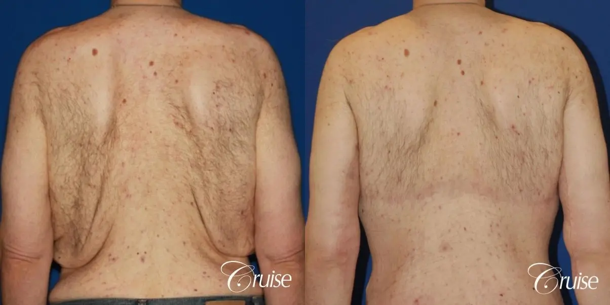 severe weight loss gynecomastia upper body lift - Before and After 4