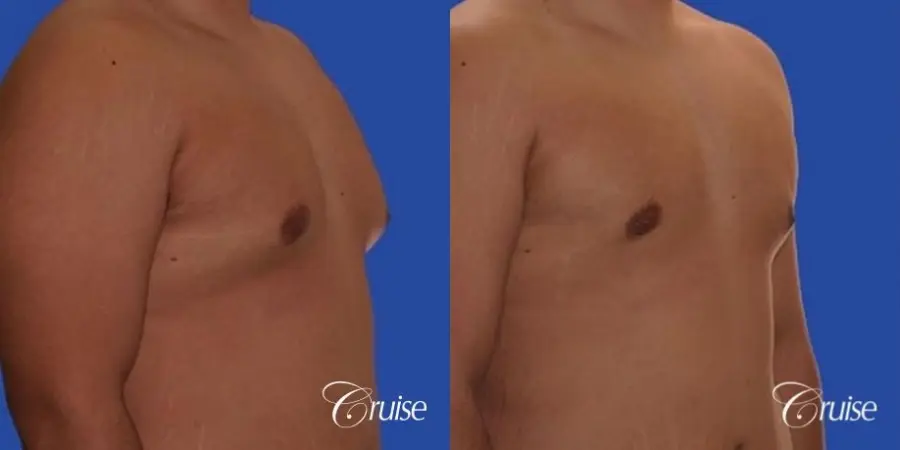 mild gyne on 24yr old adult - Before and After 4