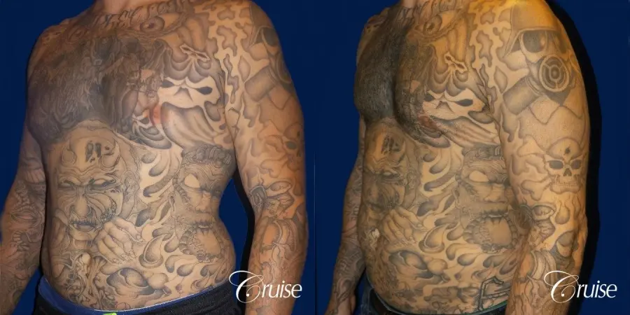 Moderate Gynecomastia Areola Incision - Before and After 3
