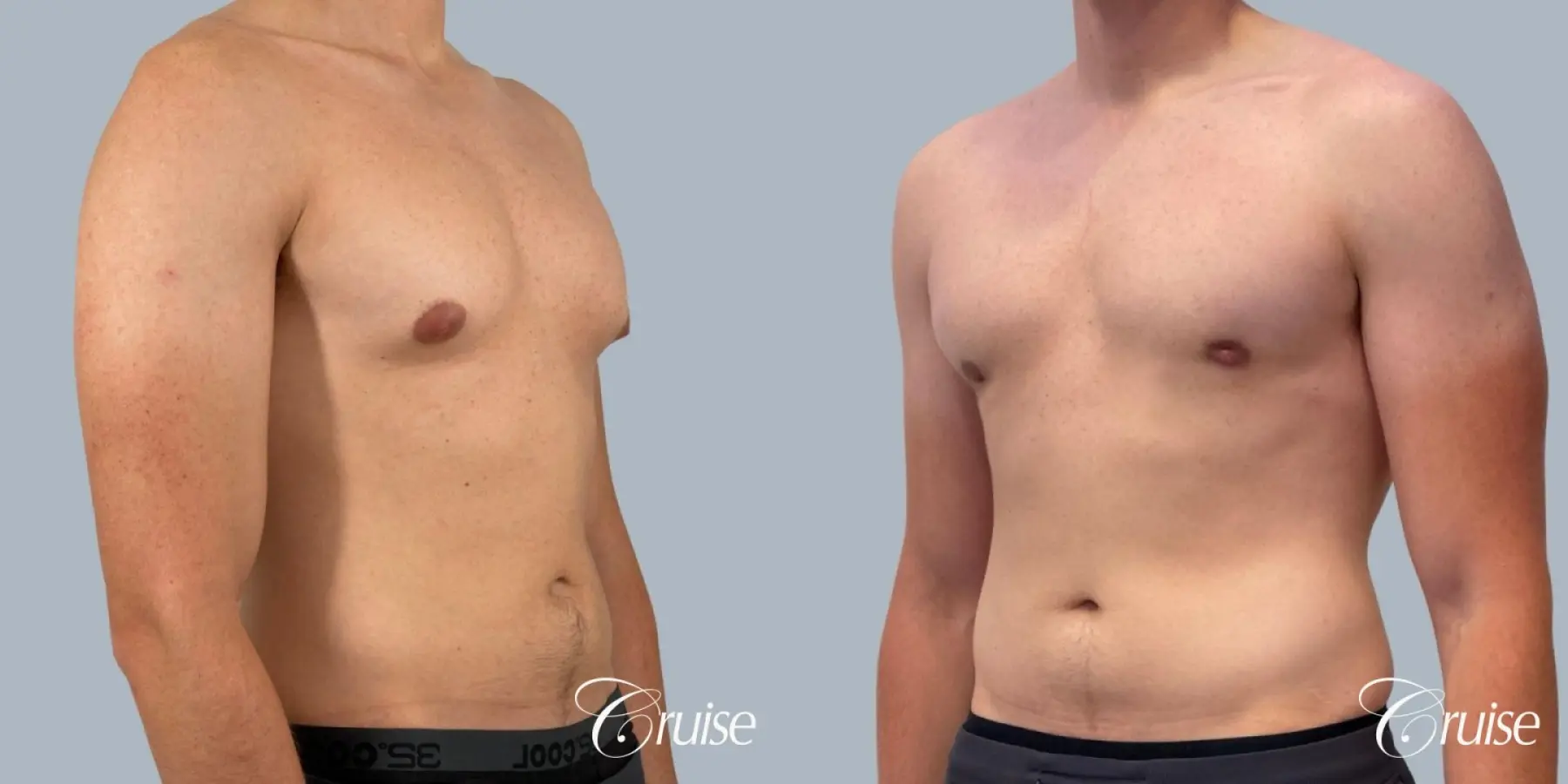 Gynecomastia: Patient 155 - Before and After 3