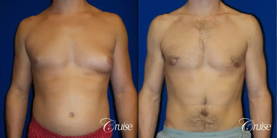 Unilateral gynecomastia - Before and After 1