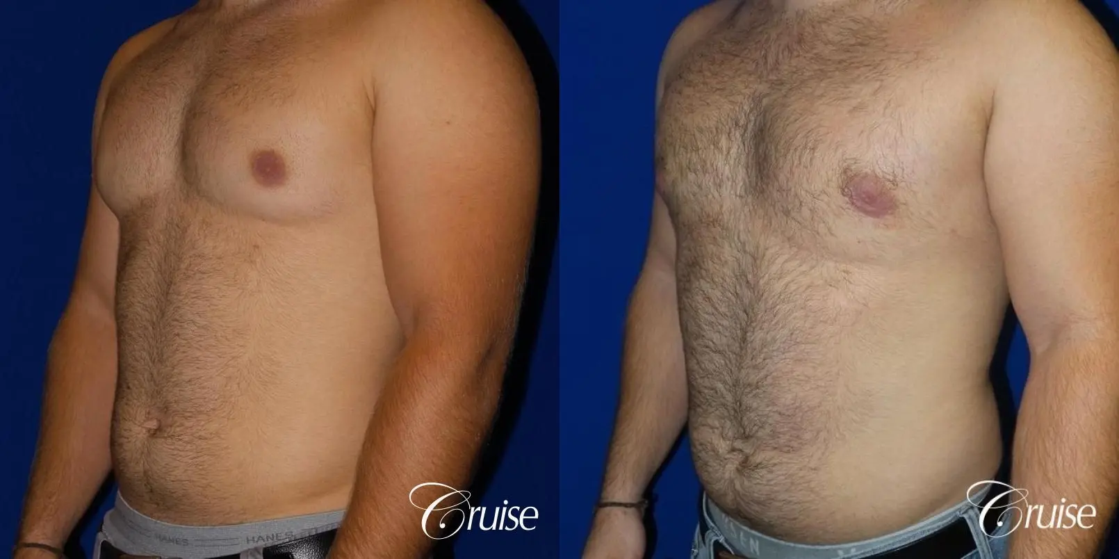 best gynecomastia results - Before and After 2