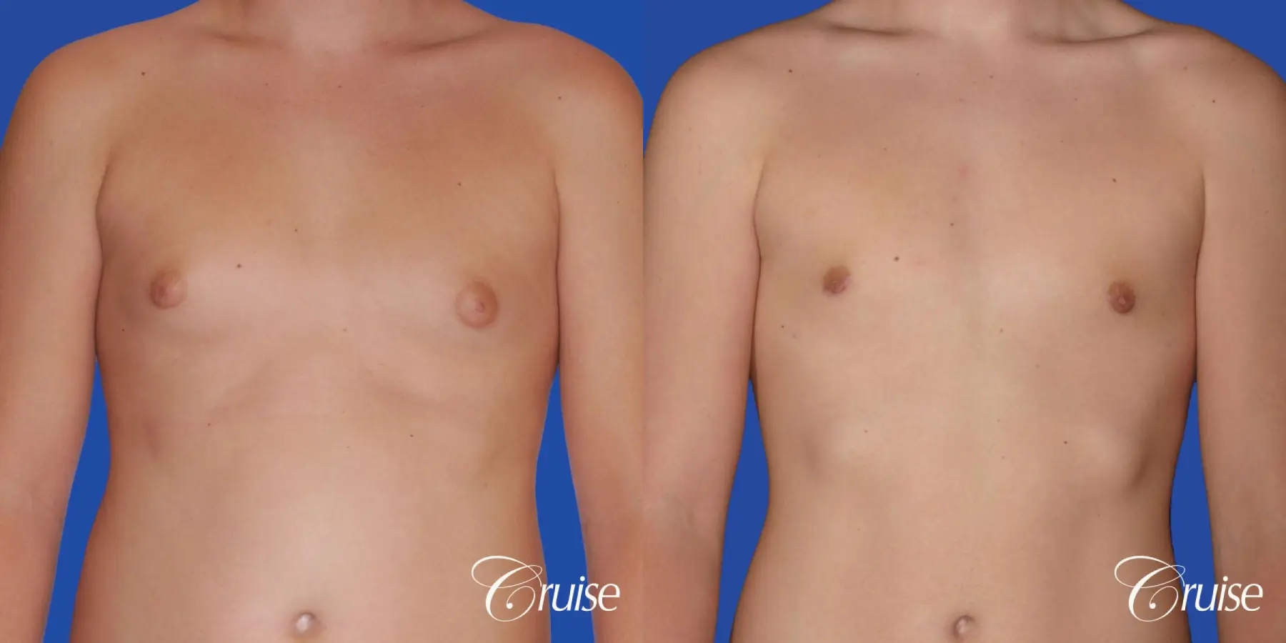 teen with pointy / puffy nipples get gynecomastia surgery - Before and After 1