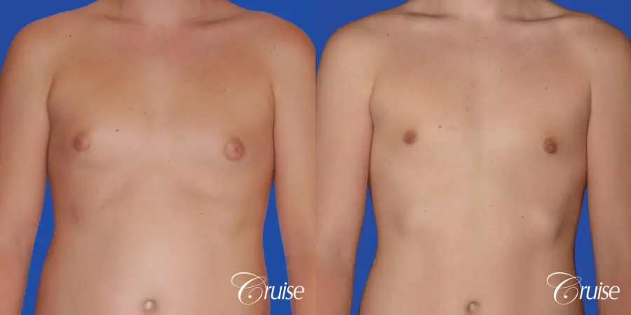 teen with pointy / puffy nipples get gynecomastia surgery - Before and After 1