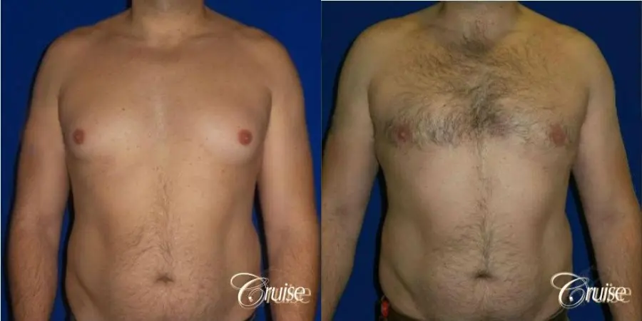 male breast reduction surgery - Before and After 1