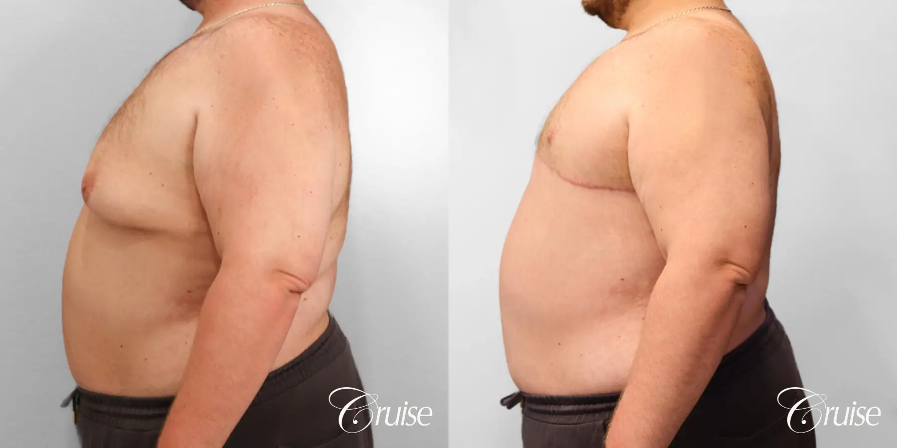 Gynecomastia: Patient 145 - Before and After 3